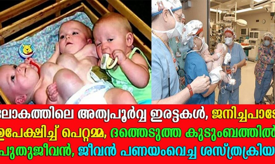 പ്രസവത്തിൽ ആ അമ്മയ്ക്ക് ജനിച്ചത് ഇരട്ട കുട്ടികൾ അതും രണ്ടെണ്ണം ഒട്ടിപ്പിടിച്ച രീതിയിലും ആരെയും അലിയിപ്പിക്കുന്ന ഒരു കാഴ്ച