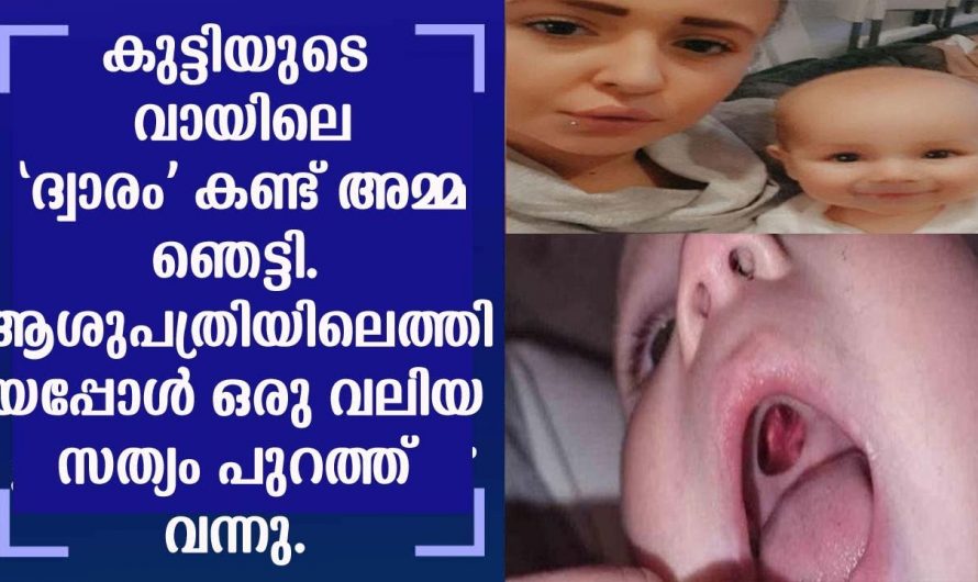 ആ കുഞ്ഞിന്റെ വായിൽ കണ്ടത് ഒരു വലിയ ദ്വാരം ആ കുഞ്ഞിനെയും കൊണ്ട് ഓടി ഡോക്ടറുടെ അടുത്തേക്ക് പോയപ്പോൾ ആ ഡോക്ടർ പറഞ്ഞത് കേട്ടോ